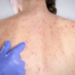 Medicamento reduz em até 85% internações no SUS por fibrose cística